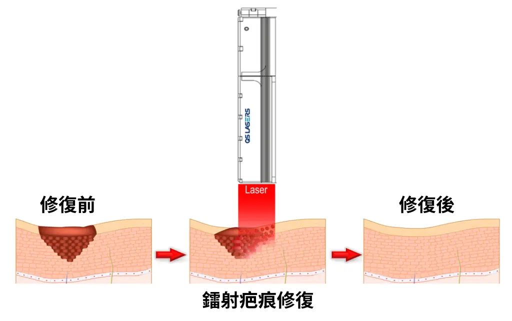 疤痕修復